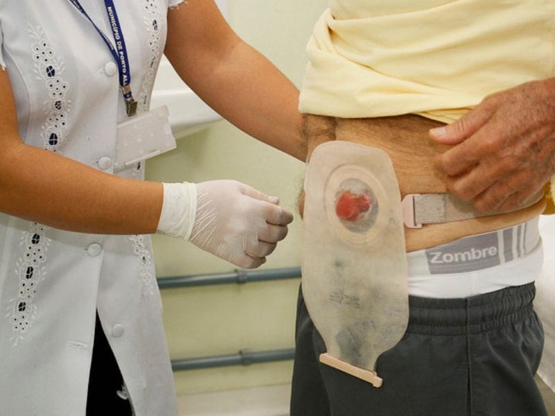Ostomía